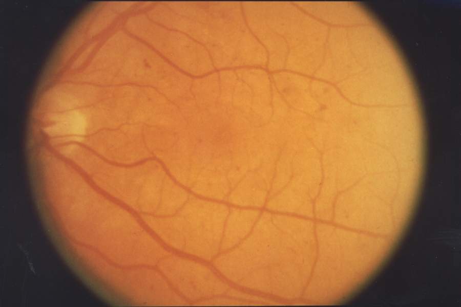 Retinal fundus image